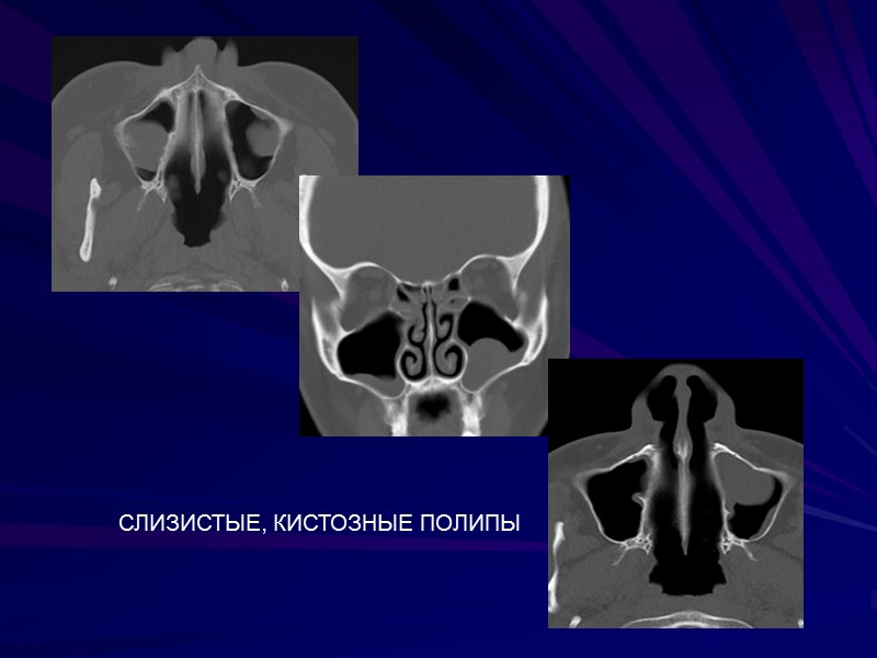 СЛИЗИСТЫЕ, КИСТОЗНЫЕ ПОЛИПЫ